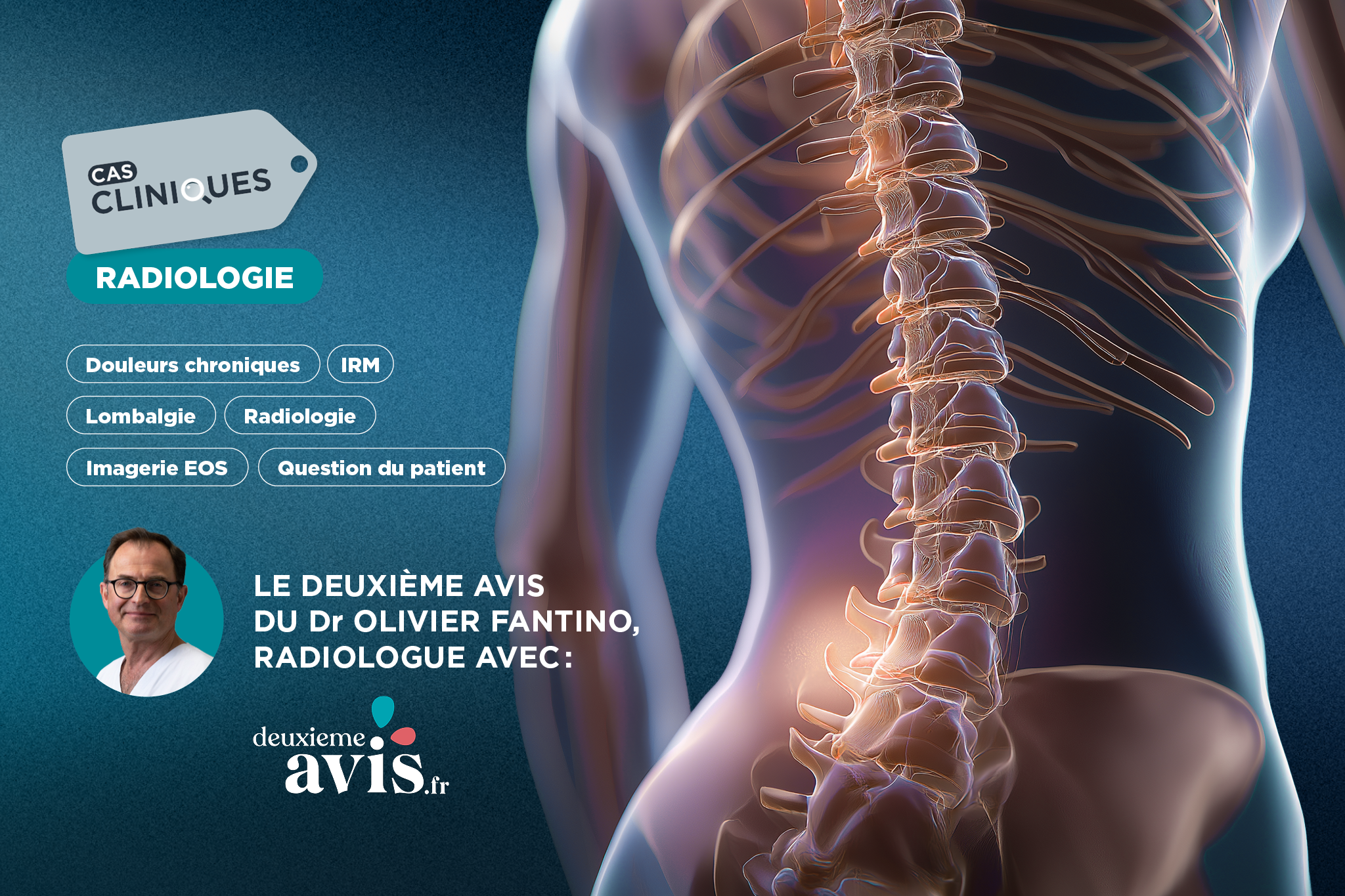 Cas clinique en radiologie du Dr Olivier Fantino : douleurs lombaires chroniques persistantes d’une jeune adulte avec un résultat d'IRM revenu négatif :  quels examens et stratégies thérapeutiques ?