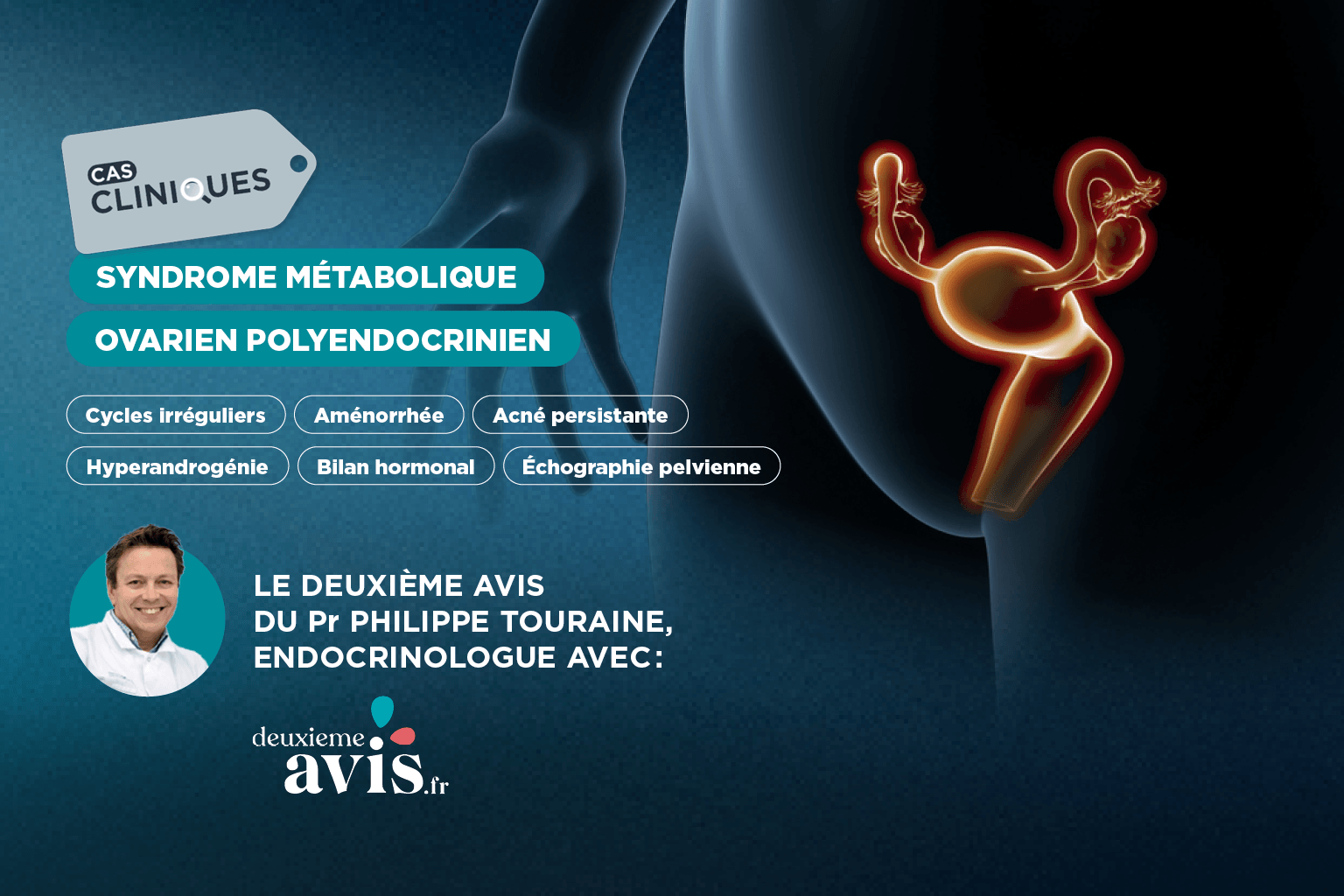 Cas clinique en santé de la femme du Pr Philippe Touraine : Quand être sûr de pouvoir poser un diagnostic de SMOP (ex SOPK) ?