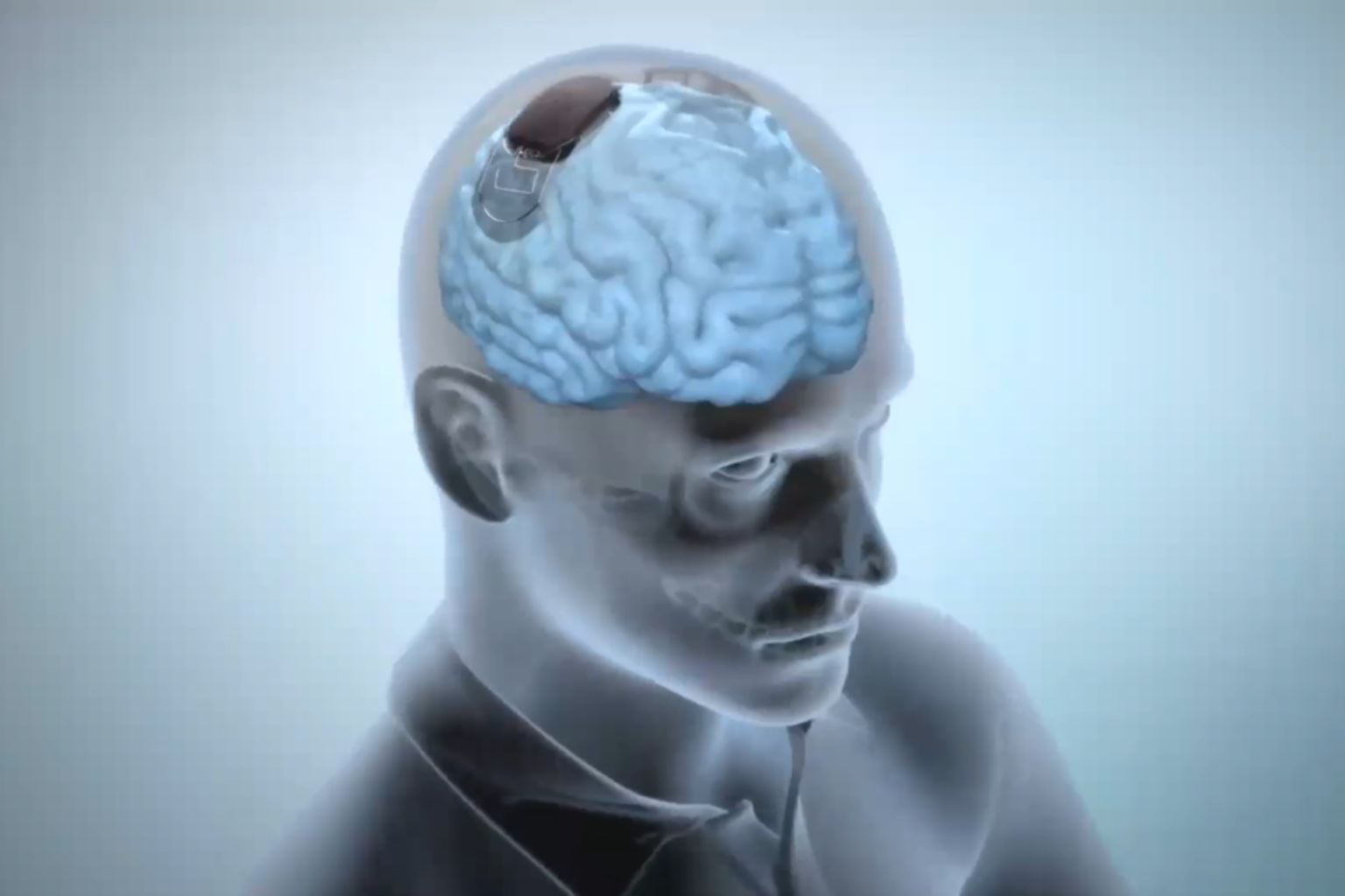 Remarcher par la pensée : la révolution neurotech de Grenoble