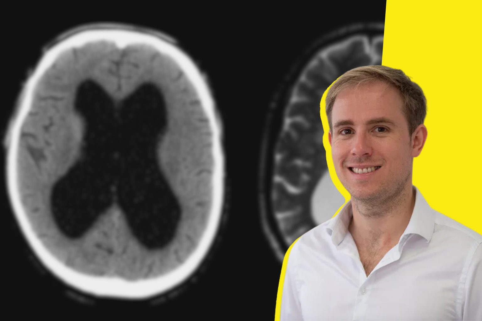 Dr Thibault Portella, neurochirurgien et fondateur d’EchoPoLe : « La dérivation ventriculaire est le dernier acte chirurgical réalisé à l’aveugle malgré les risques encourus, nous allons y remédier » 