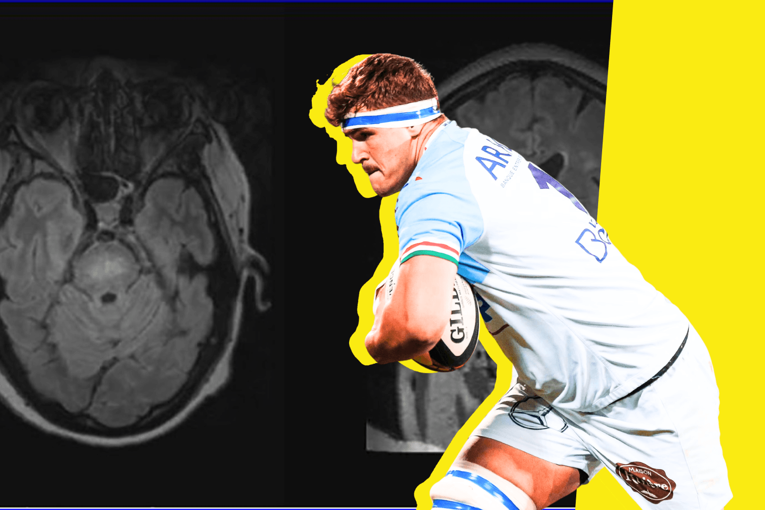 Connaissez-vous le syndrome opsoclonus-myoclonus, cette maladie auto-immune ultra-rare dont est atteint le rugbyman Baptiste Heguy ? 