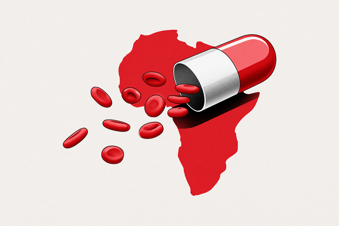 Drépanocytose : au Sénégal, un générique local d'hydroxyurée suscite l'espoir des patients