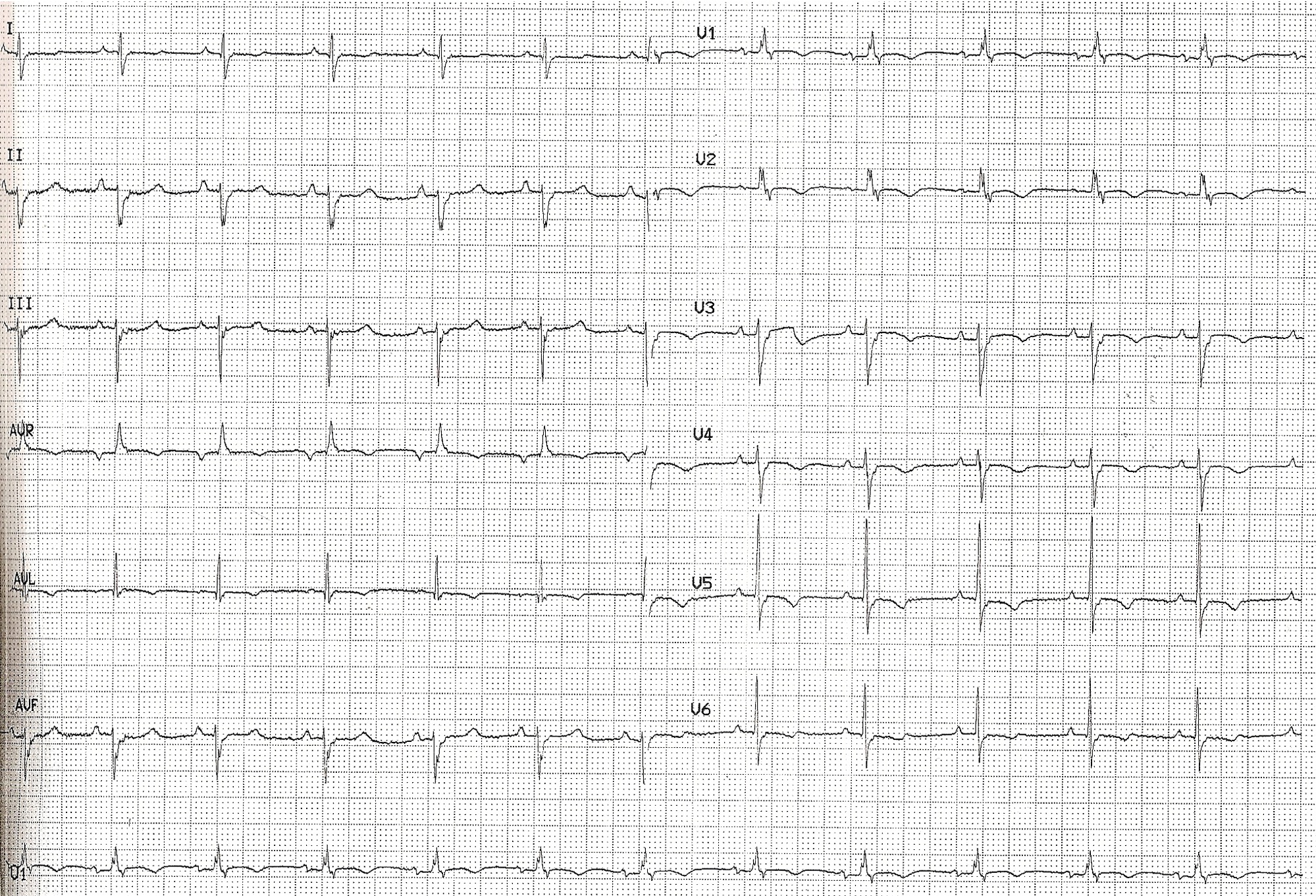 ECG