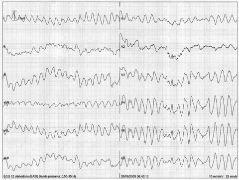 Pic d'adrénaline et palpitations