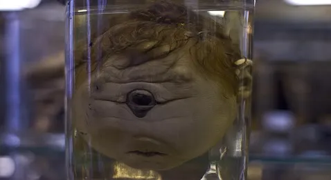 Dernier appel pour le musée Dupuytren