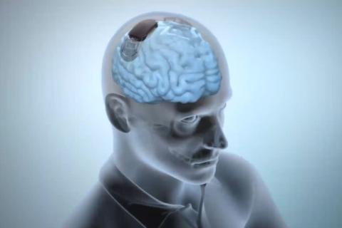 Remarcher par la pensée : la révolution neurotech de Grenoble