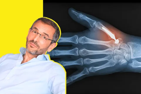 Dr Joël Rezzouk : « Dans l’arthrose du pouce, dire à un patient qu’il est trop jeune pour une prothèse n’a aucun sens »