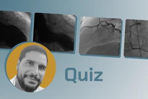 Le Quiz Cardiologie du Dr Julien Adjedj : Quel est le diagnostic de cette patiente ?