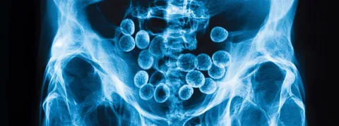 CHU de Besançon, une opération particulière pour extraire un ovule de cocaïne bloqué dans l'abdomen