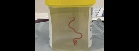 Un ver « vivant et se tortillant » extrait du cerveau d’une patiente, une première