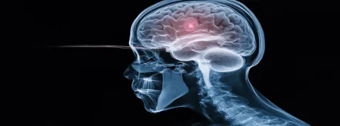 Un traitement français contre le cancer du cerveau va être commercialisé aux États-Unis