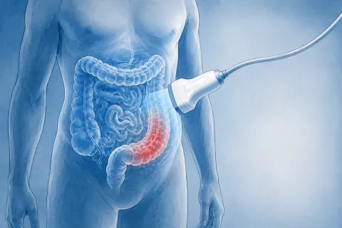 Échographie intestinale : « Une coloscopie sur deux pourrait être évitée dans le suivi des MICI », selon le Pr Mathurin Fumery