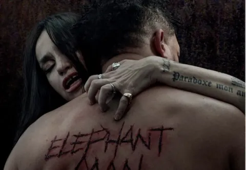  Elephant Man : monstruosités médicales