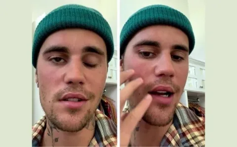 Justin Bieber atteint du syndrome de Ramsay Hunt, mais c’est quoi ça déjà ?