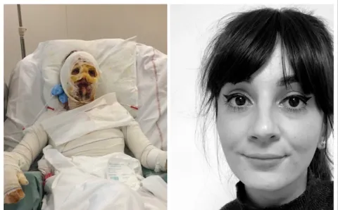 Connaissez-vous le syndrome de Lyell ?