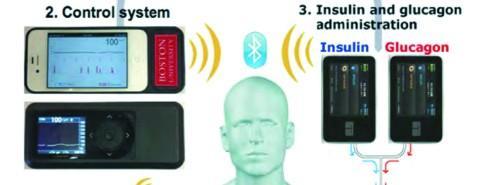 Un premier pancréas connecté
