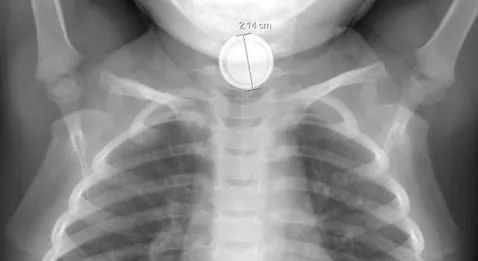 Urgences : le miel à la rescousse