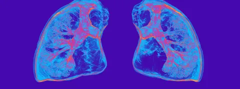 Cancer du poumon : lancement bientôt d'un vaste programme de dépistage, une étape clé dans la lutte anti-cancer