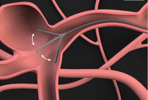 Un robot filiforme serpentera dans les vaisseaux sanguins du cerveau !