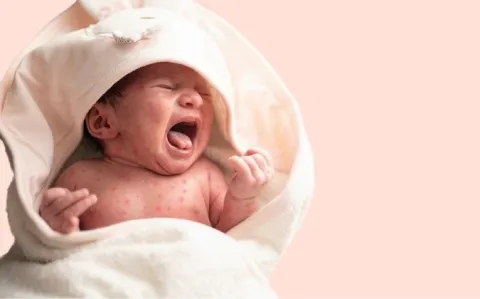 Alerte ! La rougeole pourrait toucher « des millions d’enfants » en 2022, d’après l’OMS et l’Unicef