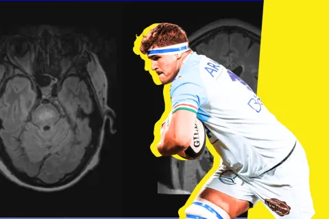 Connaissez-vous le syndrome opsoclonus-myoclonus, cette maladie auto-immune ultra-rare dont est atteint le rugbyman Baptiste Heguy ? 