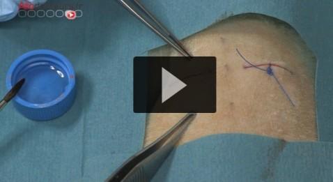 L’incroyable vidéo de la nanocolle chirurgicale